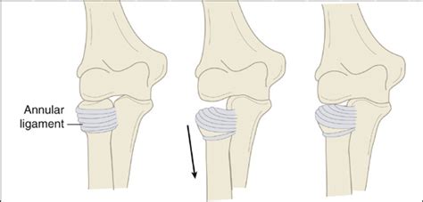 slippage of the annular ligament